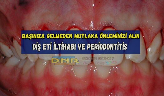 periodontitis belirtileri
